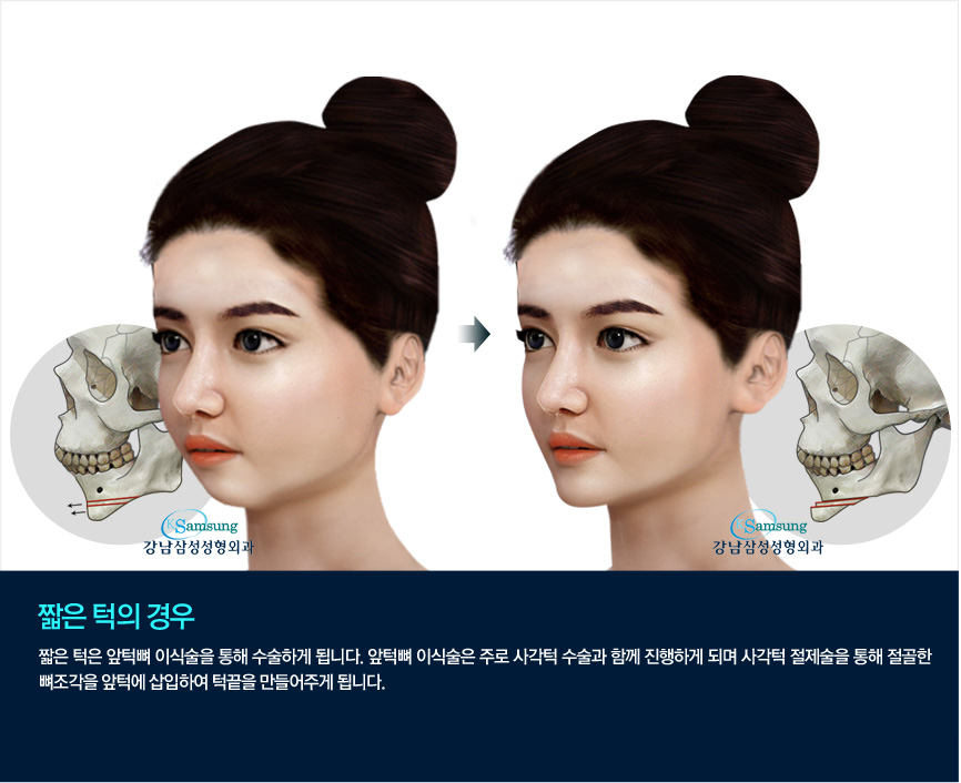 ::서울대학교 동문병원 강남삼성성형외과입니다